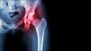 X-Ray Showing Inflammation in the Hip Joint X-Ray of a Hip Joint Inflammation